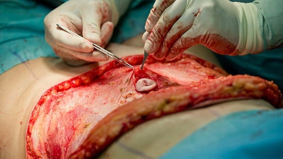 Ein Facharzt für plastisch-aesthetische Chirurgie passt bei einer anaesthesierten Patientin waehrend einer Bauchdeckenstraffung den ausgeschnittenen Bauchnabel wieder neu in die Bauchdecke ein.