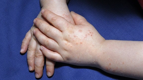Kinderhände mit Hautausschlag