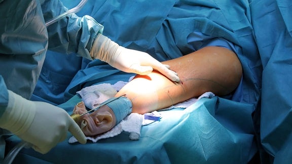 Schönheitschirurg operiert eine Patientin (25 Jahre alt) mit Lipödem an den Armen