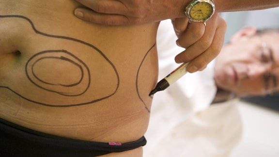 Der Arzt Dr. Jörg Blesse zeichnet 2009 an einer Patientin eine Operationslinie für die Korrektur von Bauch und Hüfte.