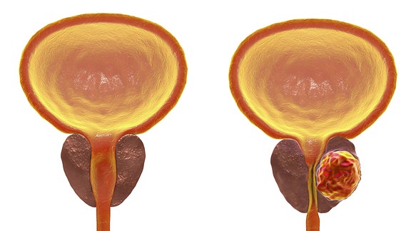 Zwei männliche Harnblasen mit Prostata im Querschnitt nebeneinander: links mit gesunder Prostata, rechts mit tumorbefallener Prostata