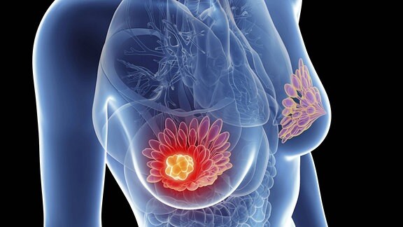 Illustration: Gläserne Frau mit Krebsherden in der Brust